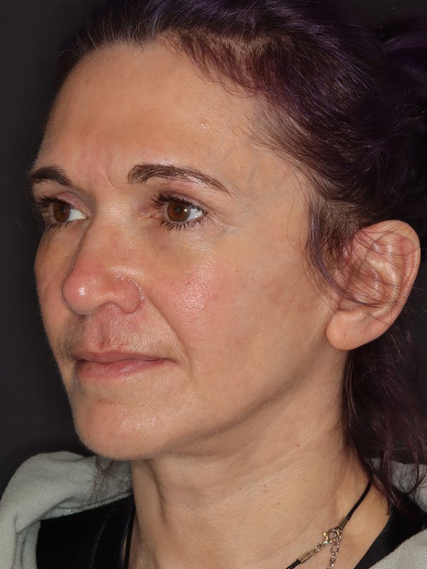 Neck Lift Gallery Before & After Gallery - Patient 543940 - Image 8