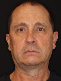 Facelift Gallery Before & After Gallery - Patient 198785 - Image 1