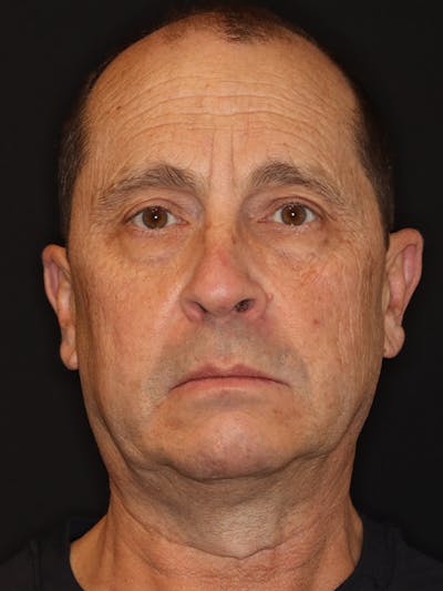 Facelift Gallery Before & After Gallery - Patient 198785 - Image 1