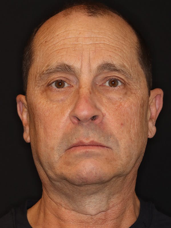 Neck Lift Gallery Before & After Gallery - Patient 135408 - Image 5