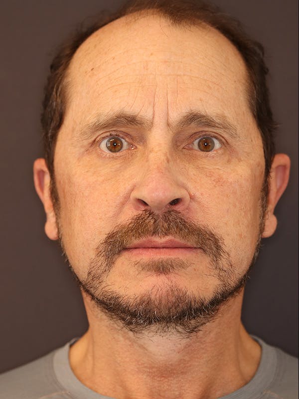 Neck Lift Gallery Before & After Gallery - Patient 135408 - Image 6