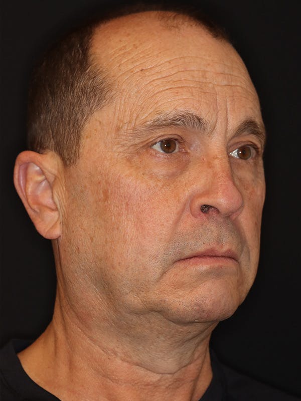 Neck Lift Gallery Before & After Gallery - Patient 135408 - Image 3