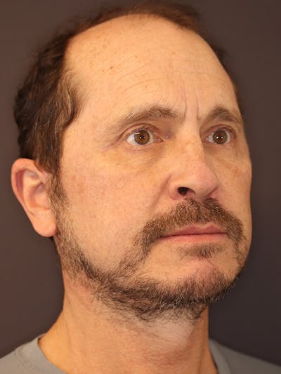 Neck Lift Gallery Before & After Gallery - Patient 135408 - Image 4