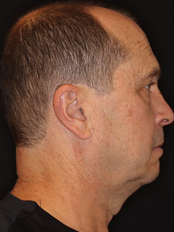 Neck Lift Gallery Before & After Gallery - Patient 135408 - Image 1
