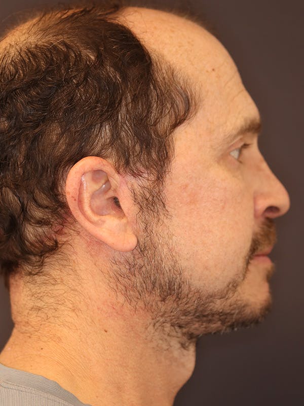 Neck Lift Gallery Before & After Gallery - Patient 135408 - Image 2