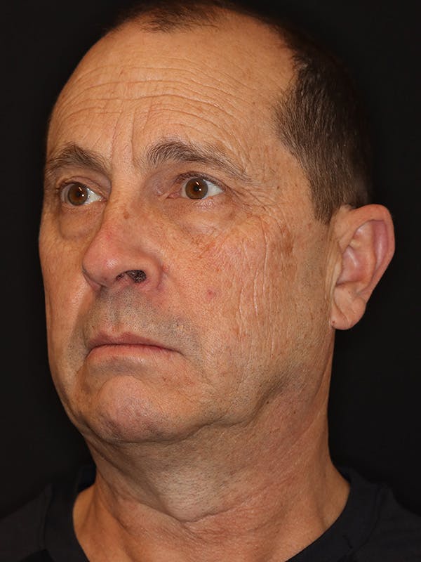 Neck Lift Gallery Before & After Gallery - Patient 135408 - Image 7