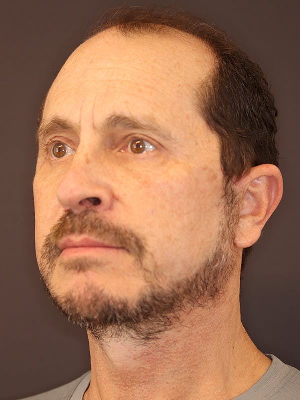 Neck Lift Gallery Before & After Gallery - Patient 135408 - Image 8