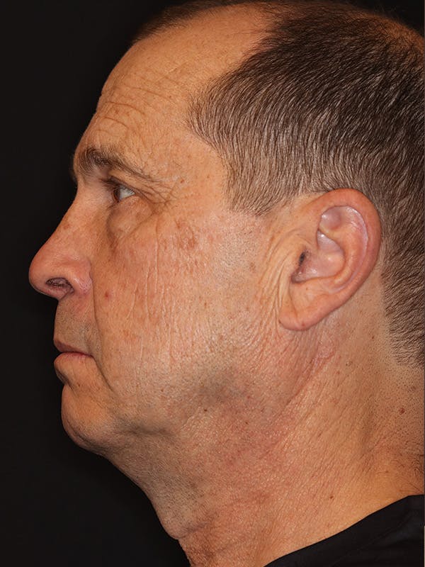 Neck Lift Gallery Before & After Gallery - Patient 135408 - Image 9