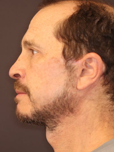Neck Lift Gallery Before & After Gallery - Patient 135408 - Image 10