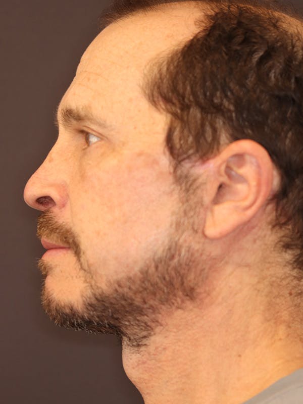 Neck Lift Gallery Before & After Gallery - Patient 135408 - Image 10