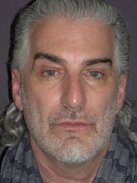 Facelift Gallery Before & After Gallery - Patient 262968 - Image 1