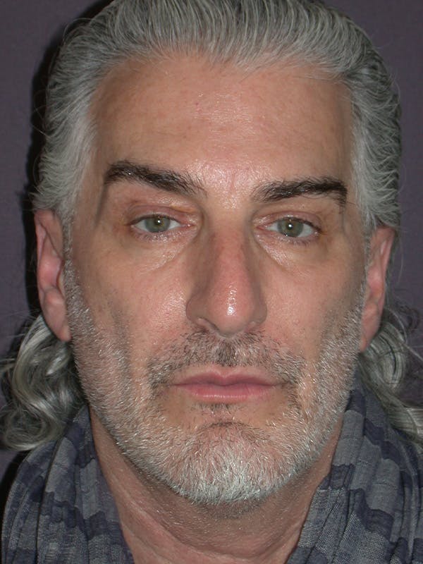Facelift Gallery Before & After Gallery - Patient 262968 - Image 1