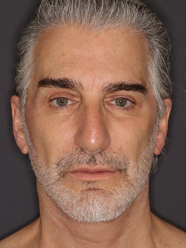 Facelift Gallery Before & After Gallery - Patient 262968 - Image 2