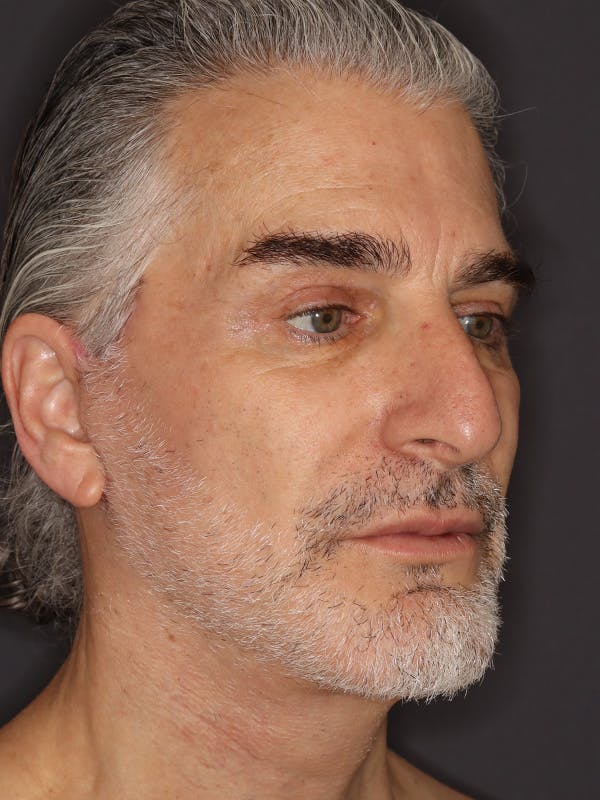 Facelift Gallery Before & After Gallery - Patient 262968 - Image 4