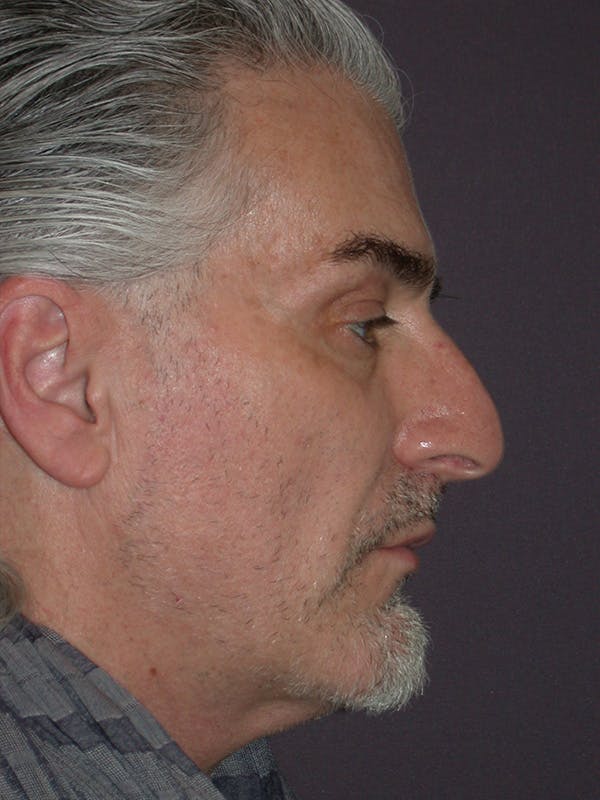 Facelift Gallery Before & After Gallery - Patient 262968 - Image 5