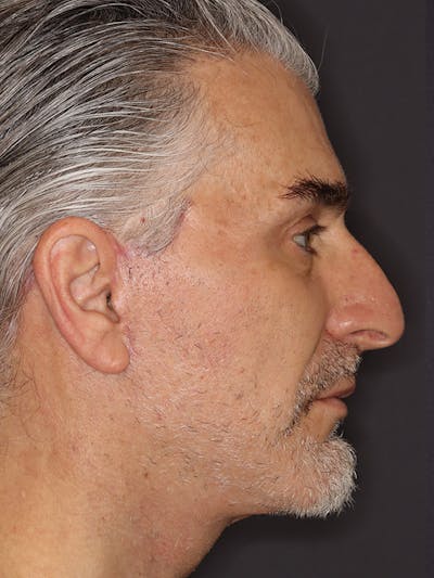 Facelift Gallery Before & After Gallery - Patient 262968 - Image 6