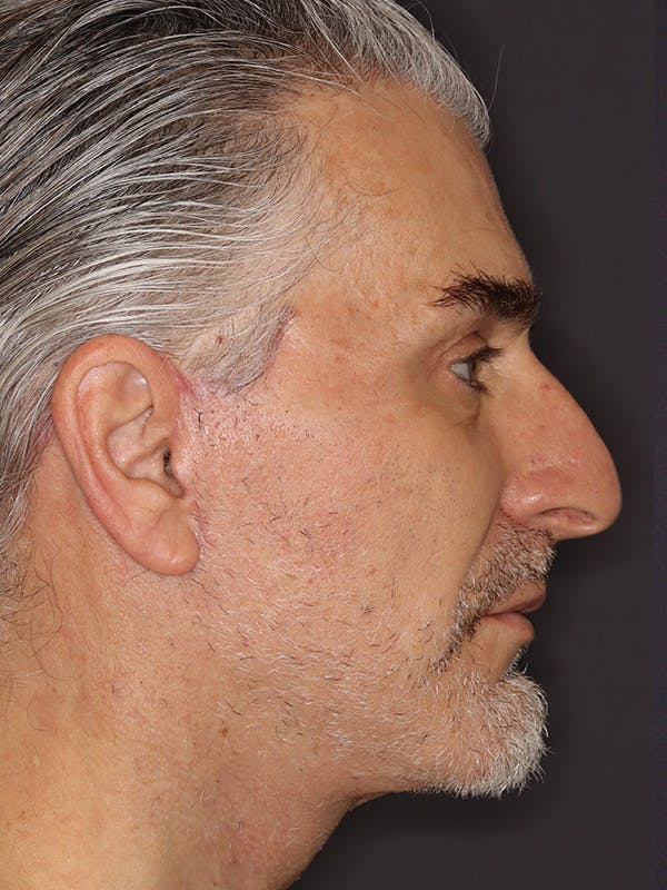 Facelift Gallery Before & After Gallery - Patient 262968 - Image 6