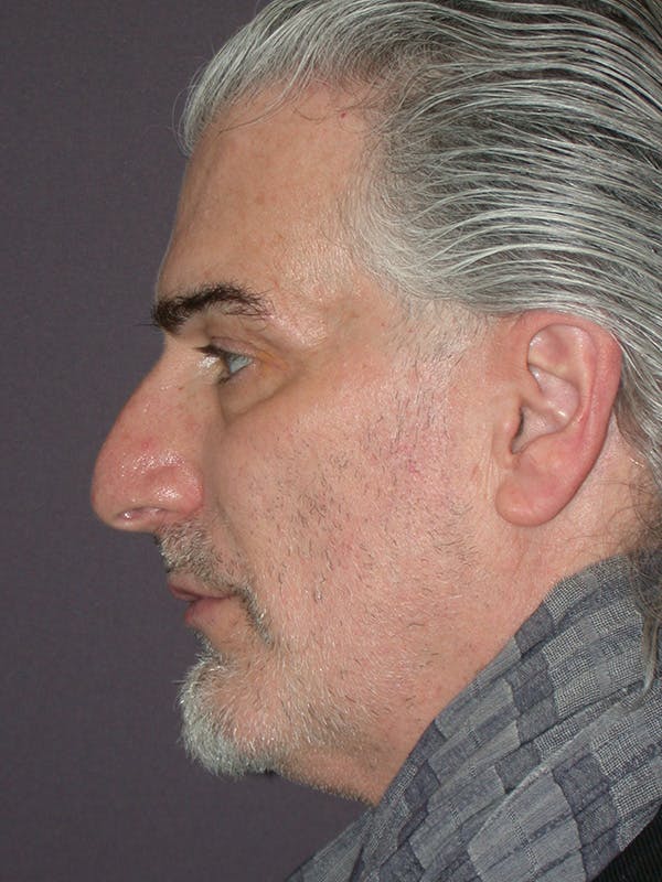 Facelift Gallery Before & After Gallery - Patient 262968 - Image 9
