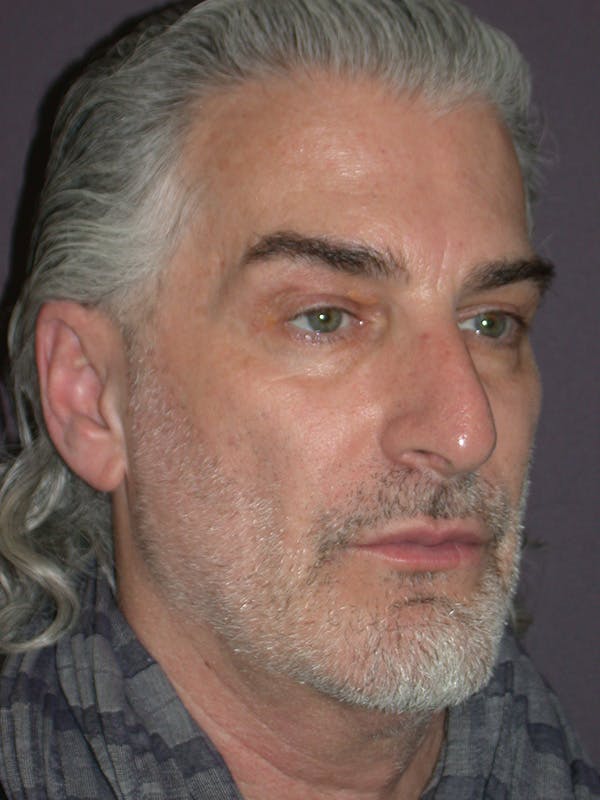 Facelift Gallery Before & After Gallery - Patient 262968 - Image 3