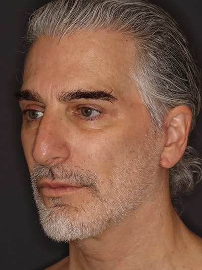 Facelift Gallery Before & After Gallery - Patient 262968 - Image 8