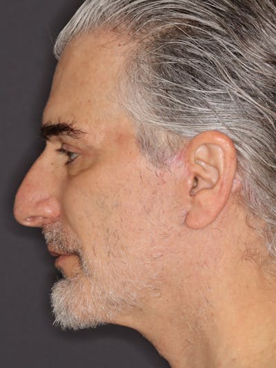 Facelift Gallery Before & After Gallery - Patient 262968 - Image 10