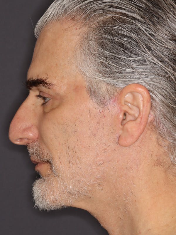 Facelift Gallery Before & After Gallery - Patient 262968 - Image 10