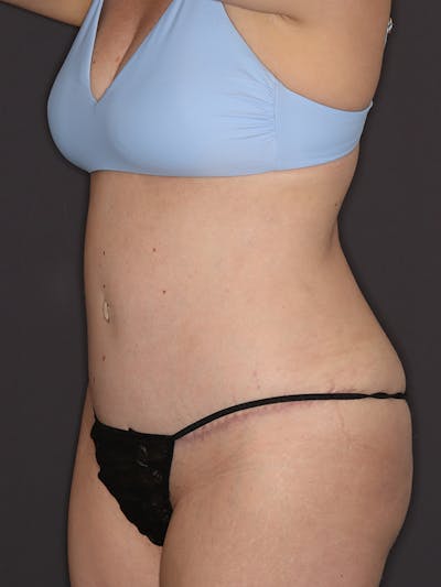 Tummy Tuck Gallery Before & After Gallery - Patient 386487 - Image 8