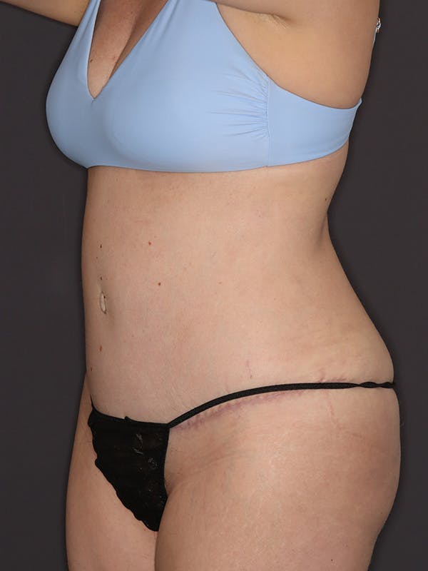 Tummy Tuck Gallery Before & After Gallery - Patient 386487 - Image 8
