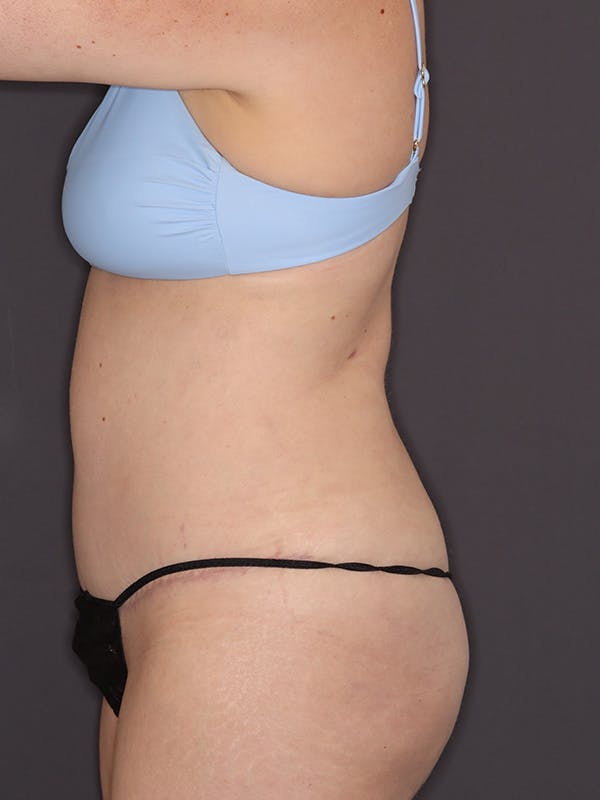 Tummy Tuck Gallery Before & After Gallery - Patient 386487 - Image 10