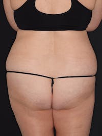 Liposuction Gallery Before & After Gallery - Patient 256745 - Image 1