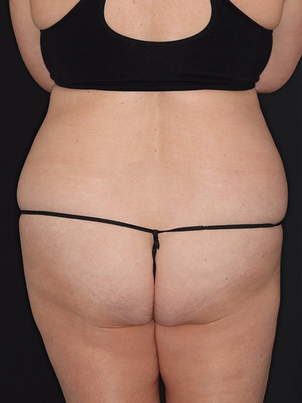 Tummy Tuck Gallery Before & After Gallery - Patient 386487 - Image 11