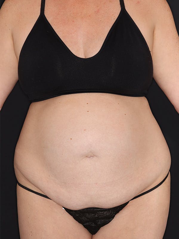 Tummy Tuck Gallery Before & After Gallery - Patient 386487 - Image 1