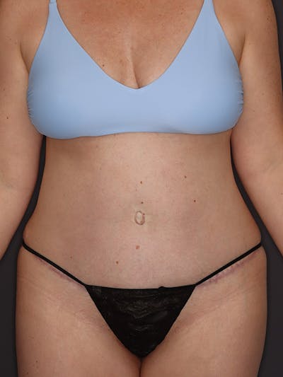 Tummy Tuck Gallery Before & After Gallery - Patient 386487 - Image 2