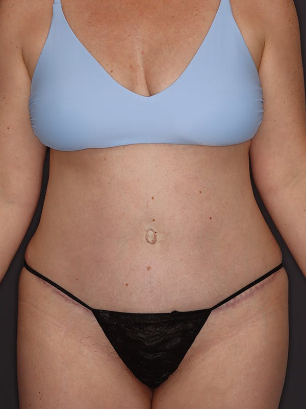 Tummy Tuck Gallery Before & After Gallery - Patient 386487 - Image 2