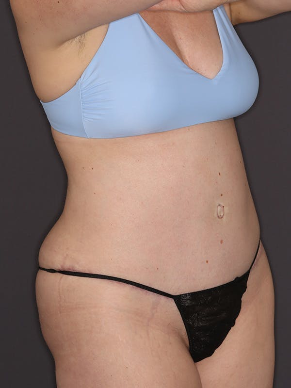 Tummy Tuck Gallery Before & After Gallery - Patient 386487 - Image 4