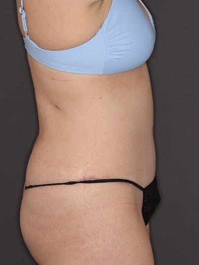 Tummy Tuck Gallery Before & After Gallery - Patient 386487 - Image 6
