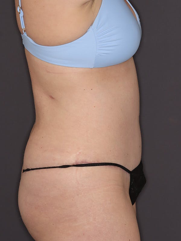 Tummy Tuck Gallery Before & After Gallery - Patient 386487 - Image 6