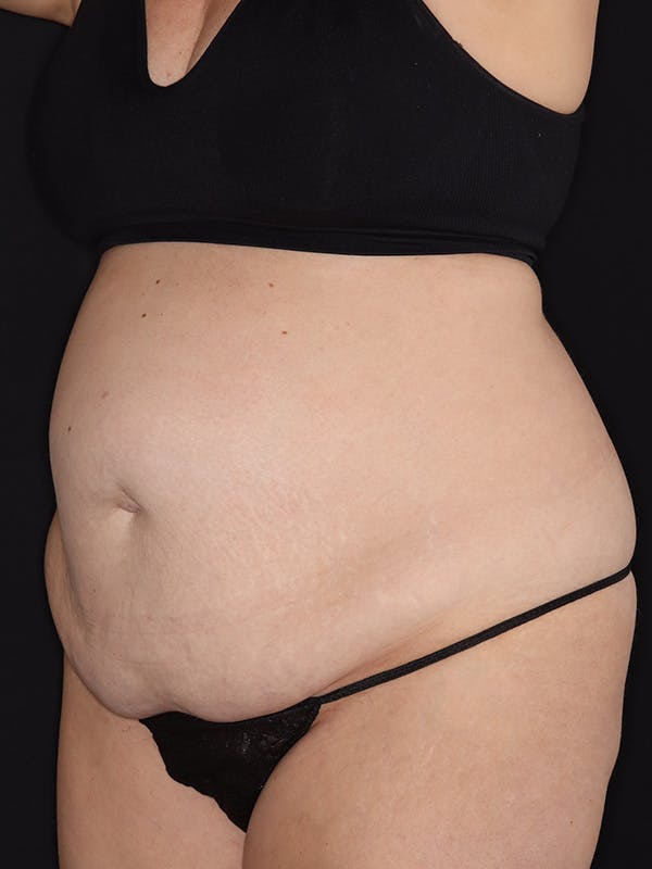 Tummy Tuck Gallery Before & After Gallery - Patient 386487 - Image 7