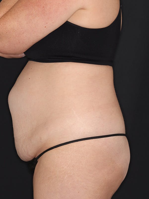 Tummy Tuck Gallery Before & After Gallery - Patient 386487 - Image 9