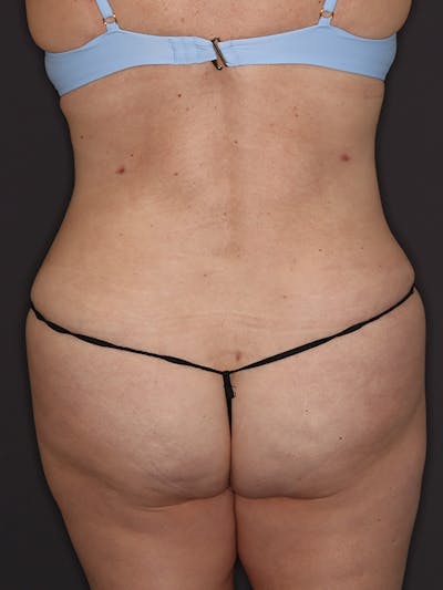 Tummy Tuck Gallery Before & After Gallery - Patient 386487 - Image 12