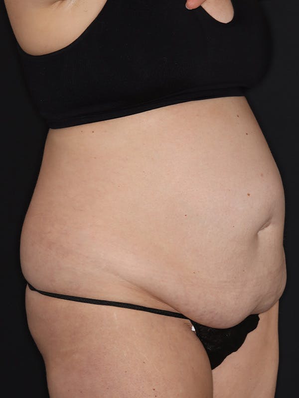 Tummy Tuck Gallery Before & After Gallery - Patient 386487 - Image 3