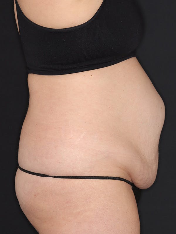 Tummy Tuck Gallery Before & After Gallery - Patient 386487 - Image 5