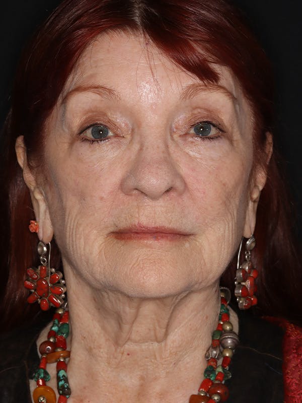 Facelift Gallery Before & After Gallery - Patient 279368 - Image 1