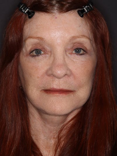 Facelift Gallery Before & After Gallery - Patient 279368 - Image 2