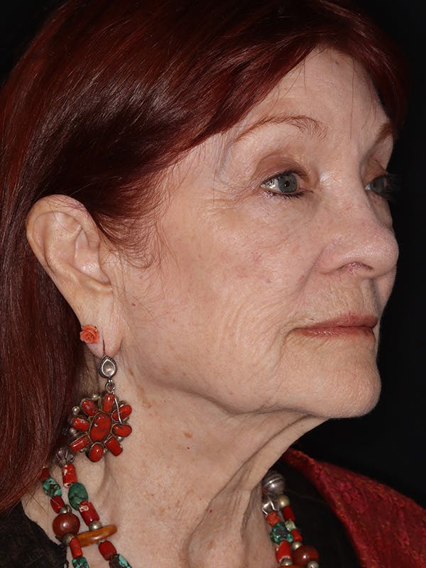 Facelift Gallery Before & After Gallery - Patient 279368 - Image 3