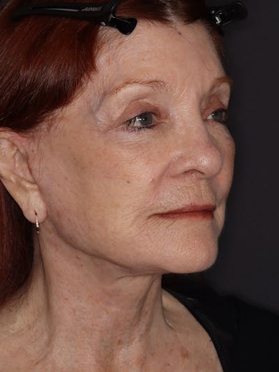 Facelift Gallery Before & After Gallery - Patient 279368 - Image 4