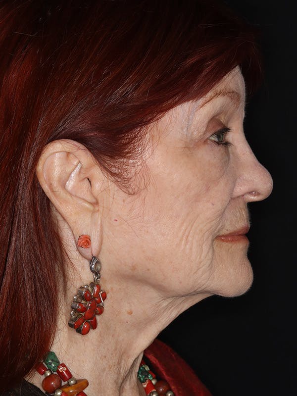 Facelift Gallery Before & After Gallery - Patient 279368 - Image 5