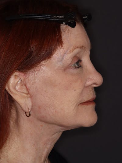 Facelift Gallery Before & After Gallery - Patient 279368 - Image 6