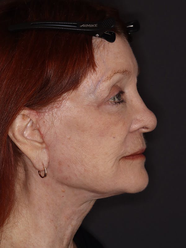 Facelift Gallery Before & After Gallery - Patient 279368 - Image 6