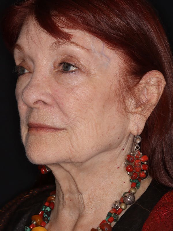 Facelift Gallery Before & After Gallery - Patient 279368 - Image 7
